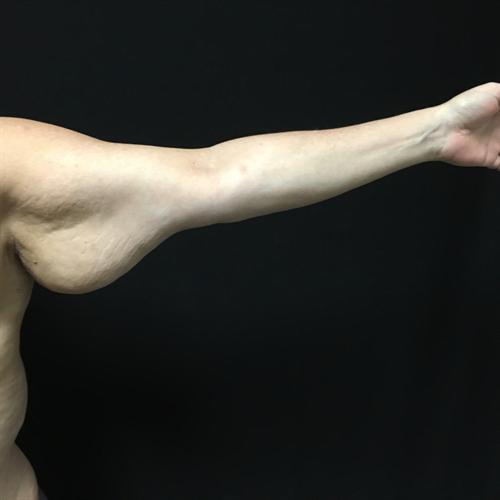 Arm Lift Before & After Image