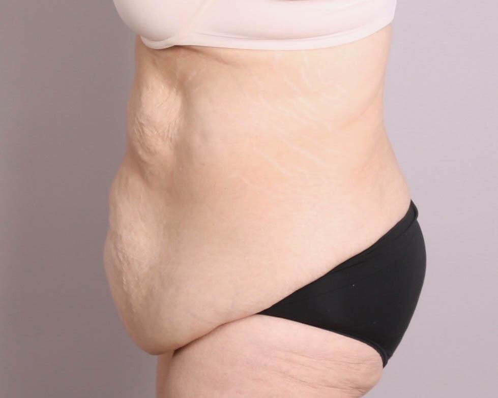 Body Lift Before & After Image