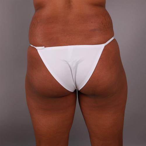 Brazilian Butt Lift Before & After Image