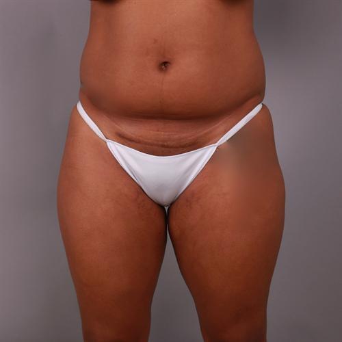 Brazilian Butt Lift Before & After Image