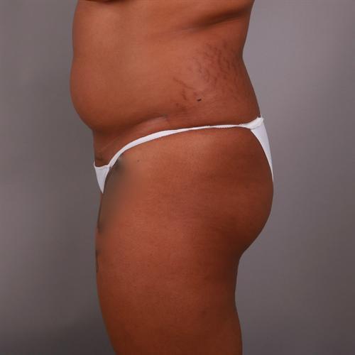 Brazilian Butt Lift Before & After Image