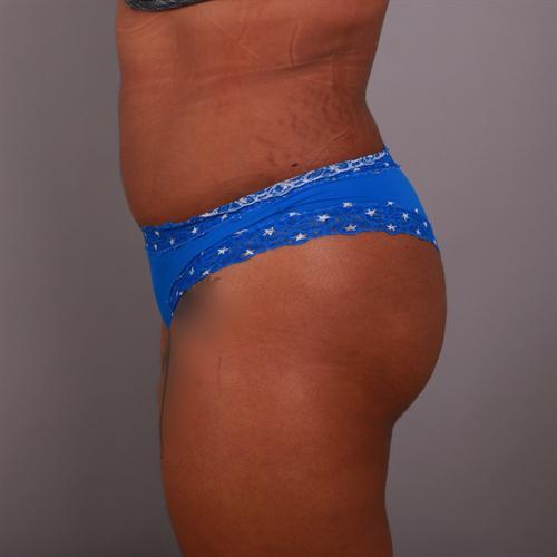 Brazilian Butt Lift Before & After Image