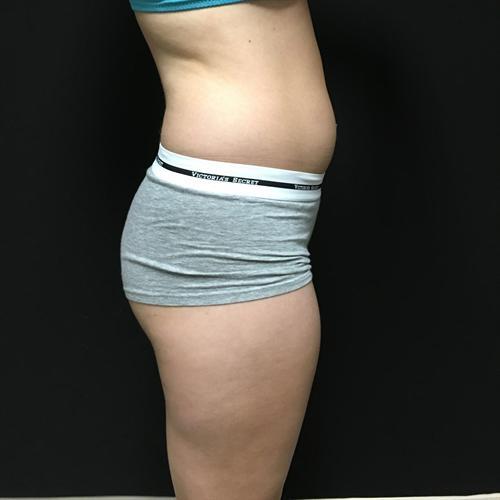 Brazilian Butt Lift Before & After Image