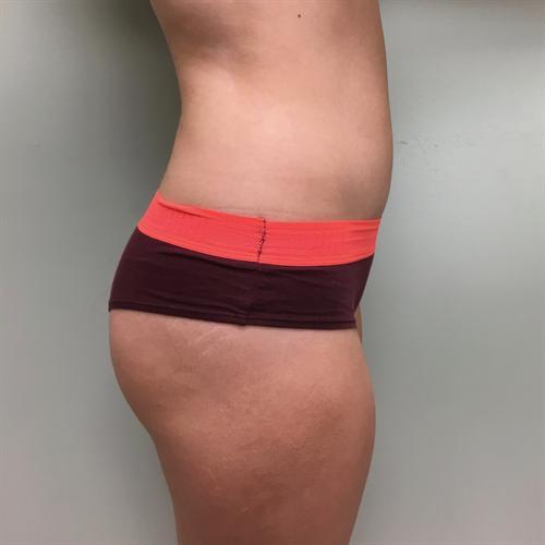 Brazilian Butt Lift Before & After Image