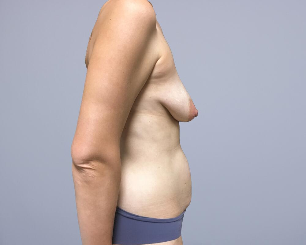 Liposuction Before & After Image