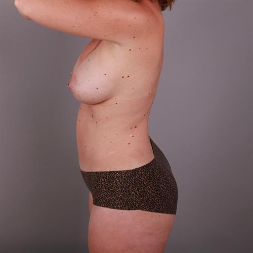 Liposuction Before & After Image