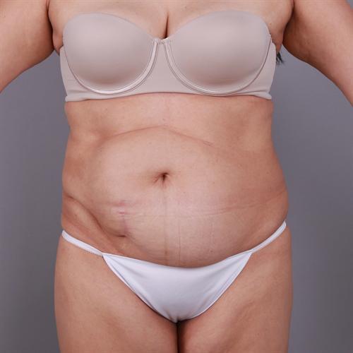 Liposuction Before & After Image