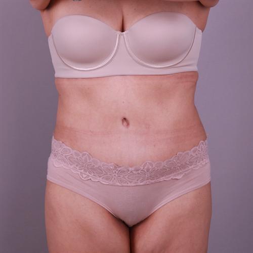 Liposuction Before & After Image