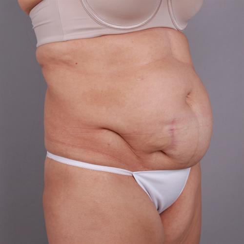 Liposuction Before & After Image