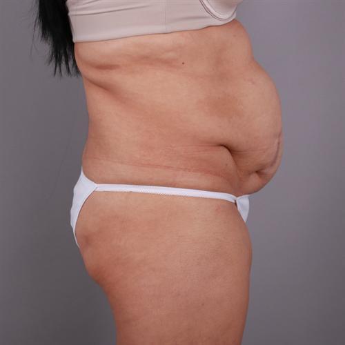 Liposuction Before & After Image