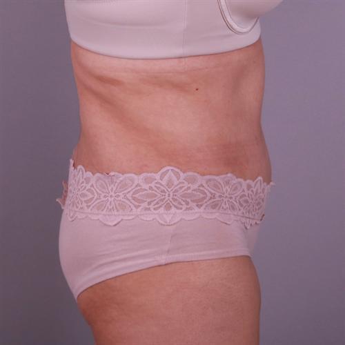 Liposuction Before & After Image