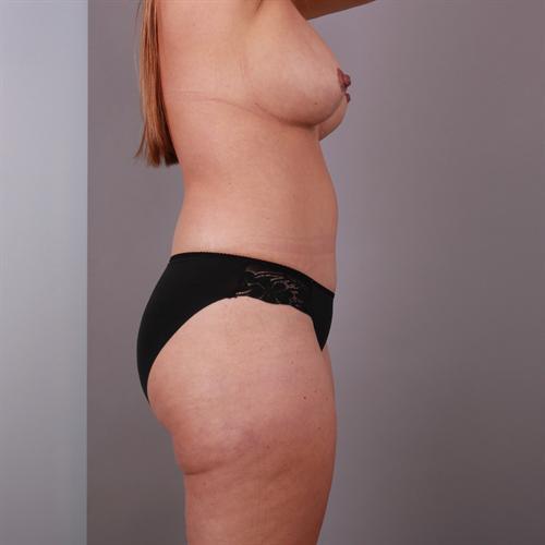 Liposuction Before & After Image