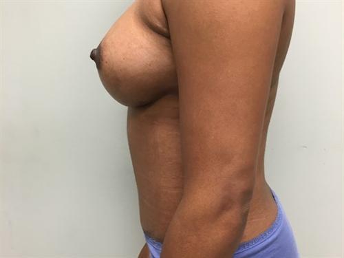 Liposuction Before & After Image