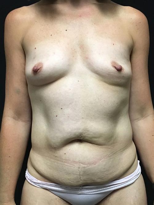 Liposuction Before & After Image