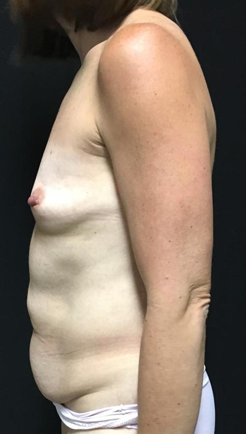 Liposuction Before & After Image