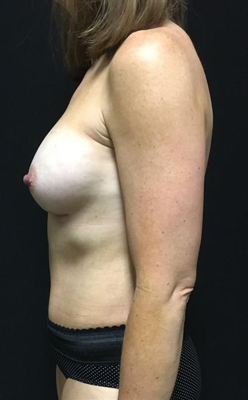 Liposuction Before & After Image