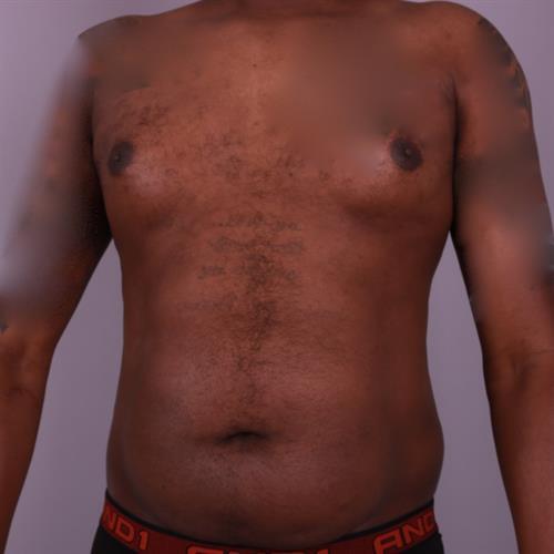 Liposuction Before & After Image