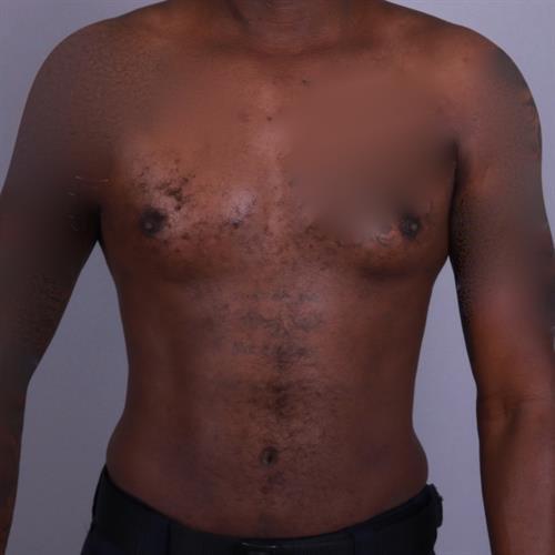 Liposuction Before & After Image