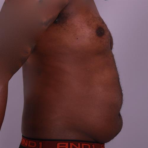 Liposuction Before & After Image