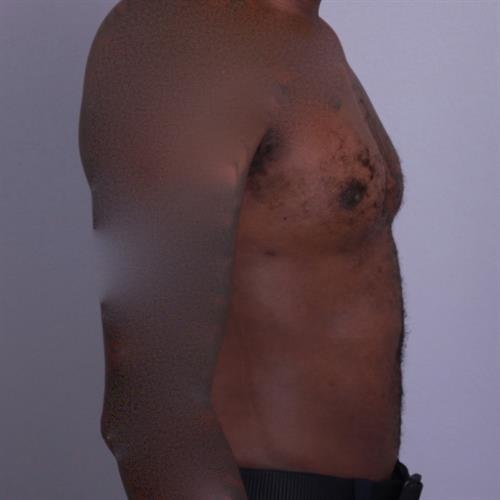 Liposuction Before & After Image