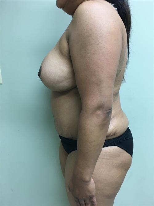 Liposuction Before & After Image