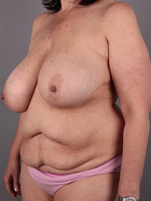 Liposuction Before & After Image