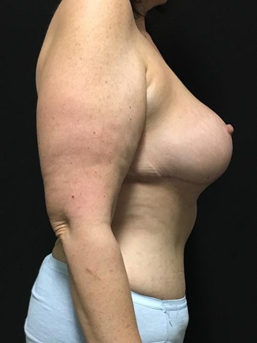 Liposuction Before & After Image