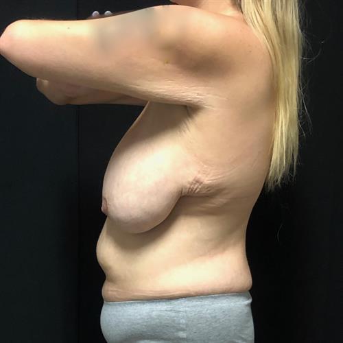 Liposuction Before & After Image