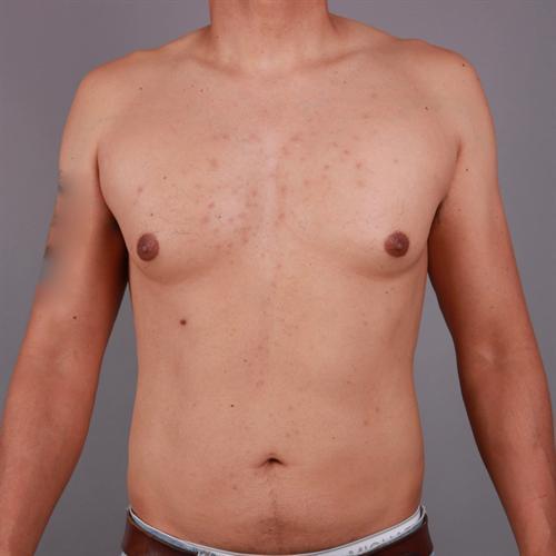 Liposuction Before & After Image