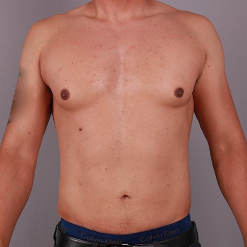 Liposuction Before & After Image