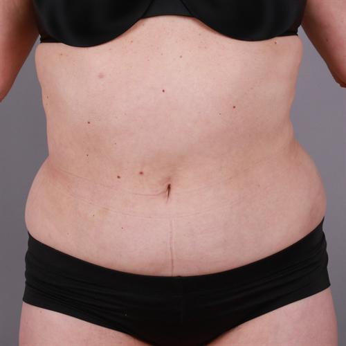 Liposuction Before & After Image