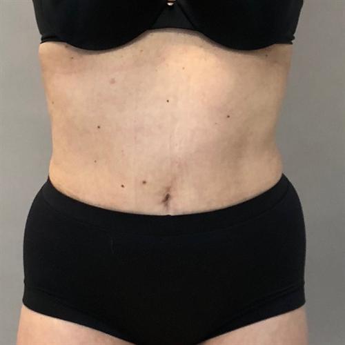 Liposuction Before & After Image