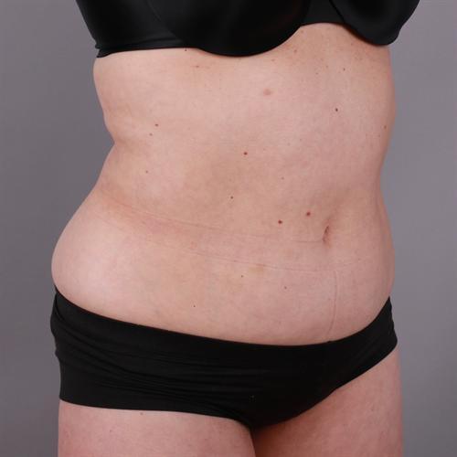 Liposuction Before & After Image