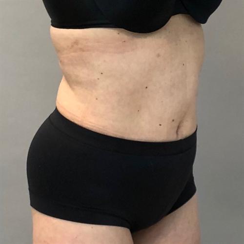 Liposuction Before & After Image