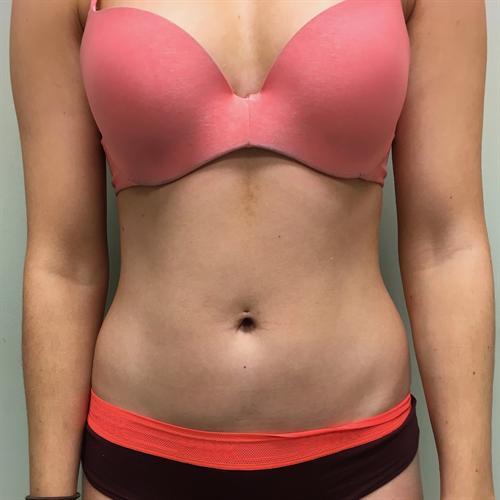 Liposuction Before & After Image