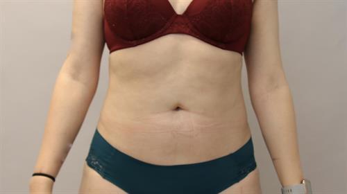 Liposuction Before & After Image