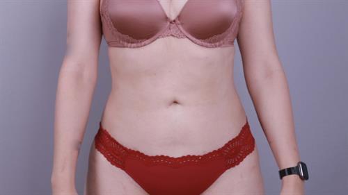 Liposuction Before & After Image