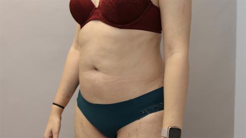 Liposuction Before & After Image