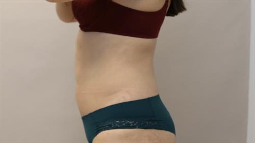 Liposuction Before & After Image