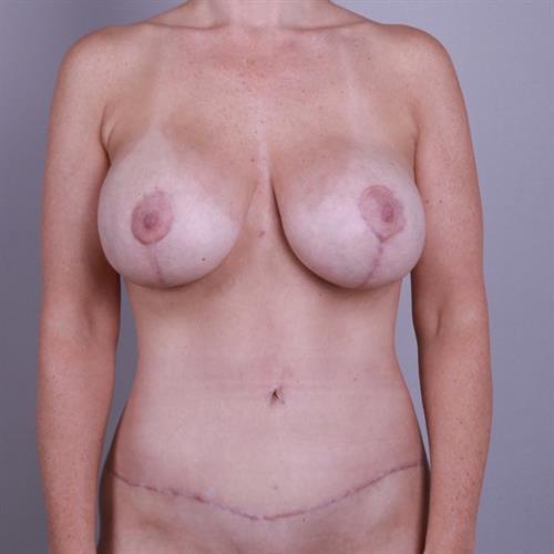 Liposuction Before & After Image