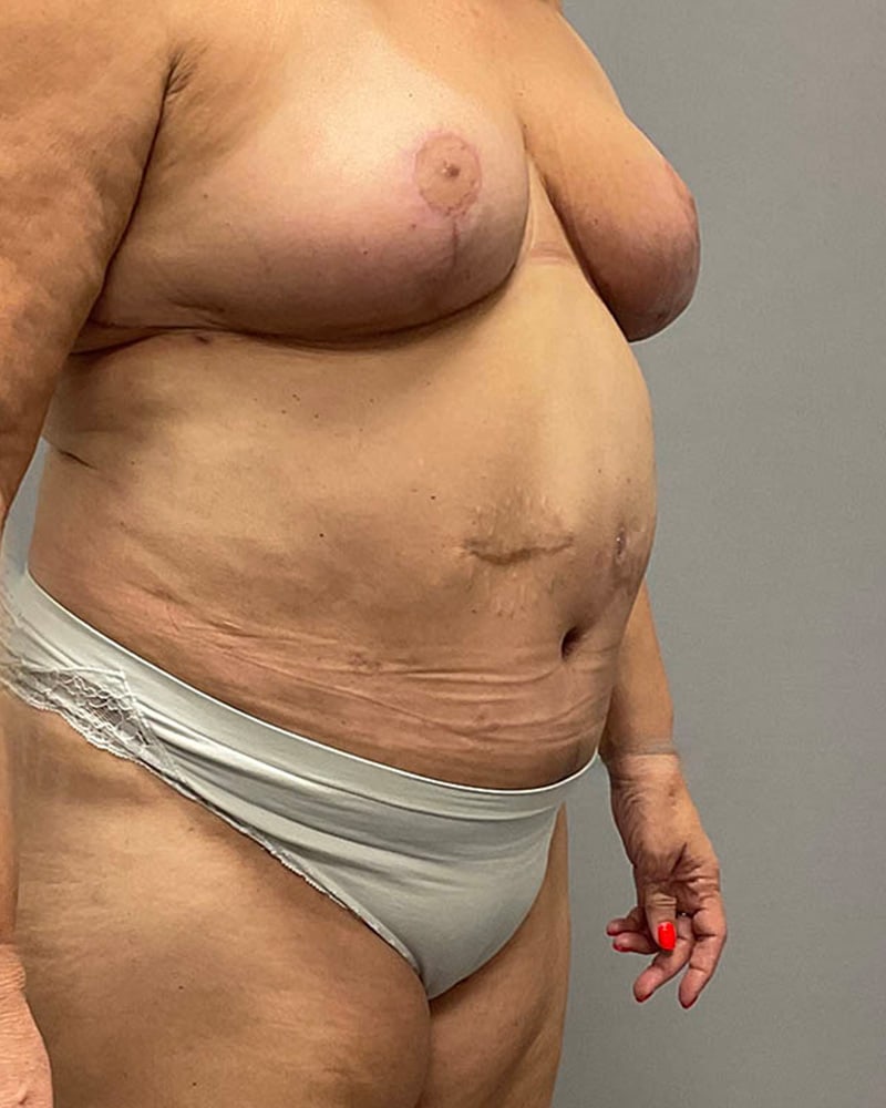 Liposuction Before & After Image