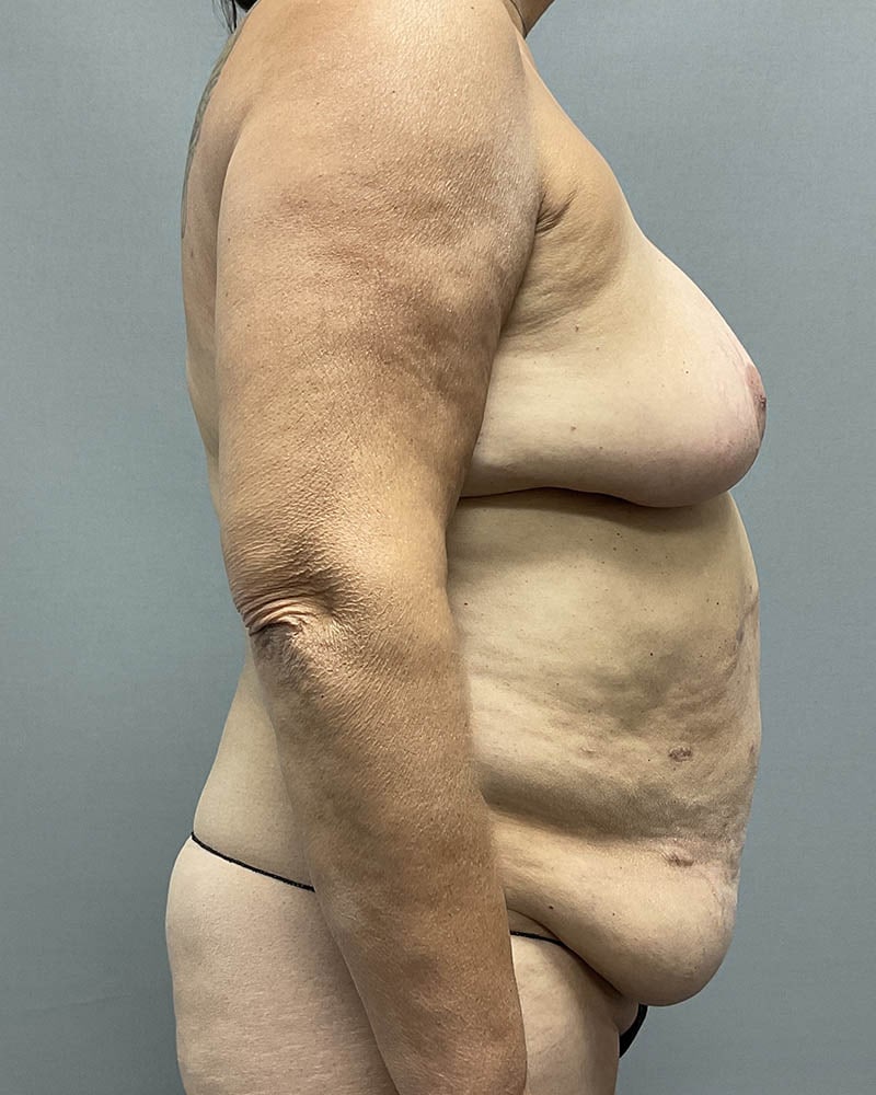 Liposuction Before & After Image