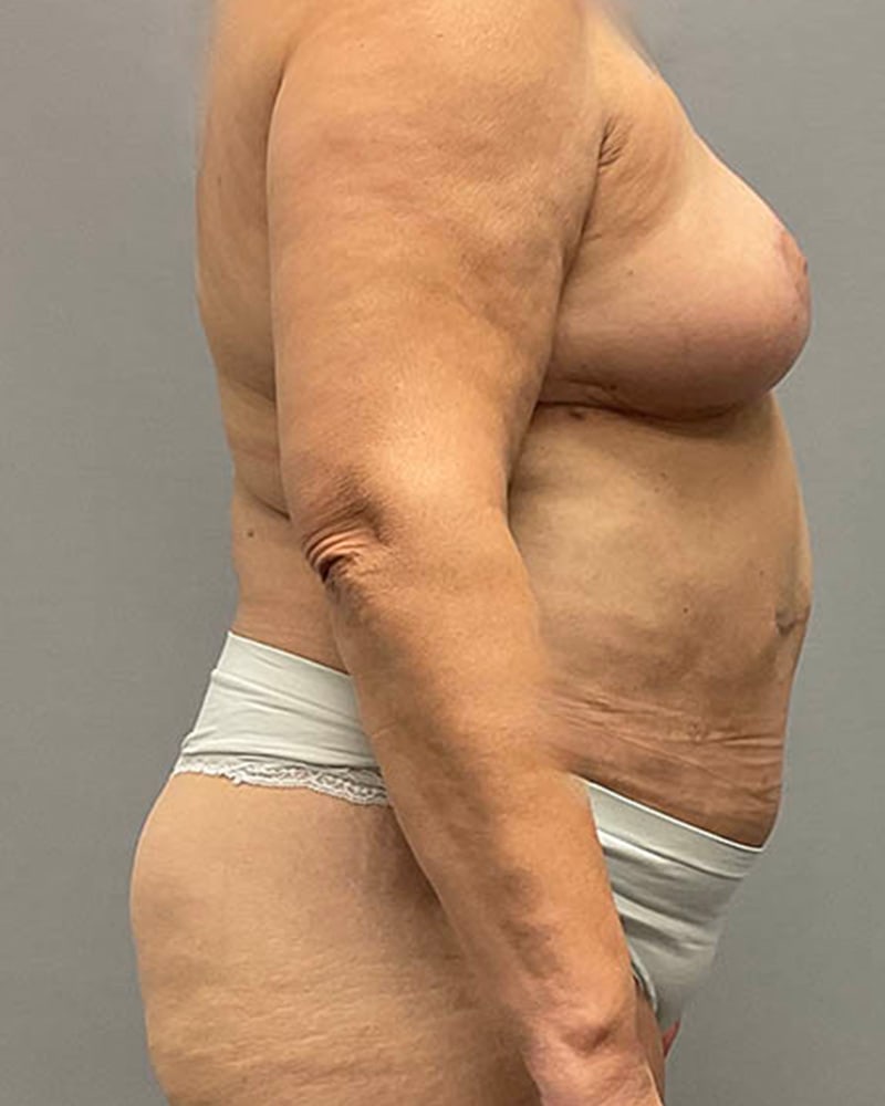 Liposuction Before & After Image