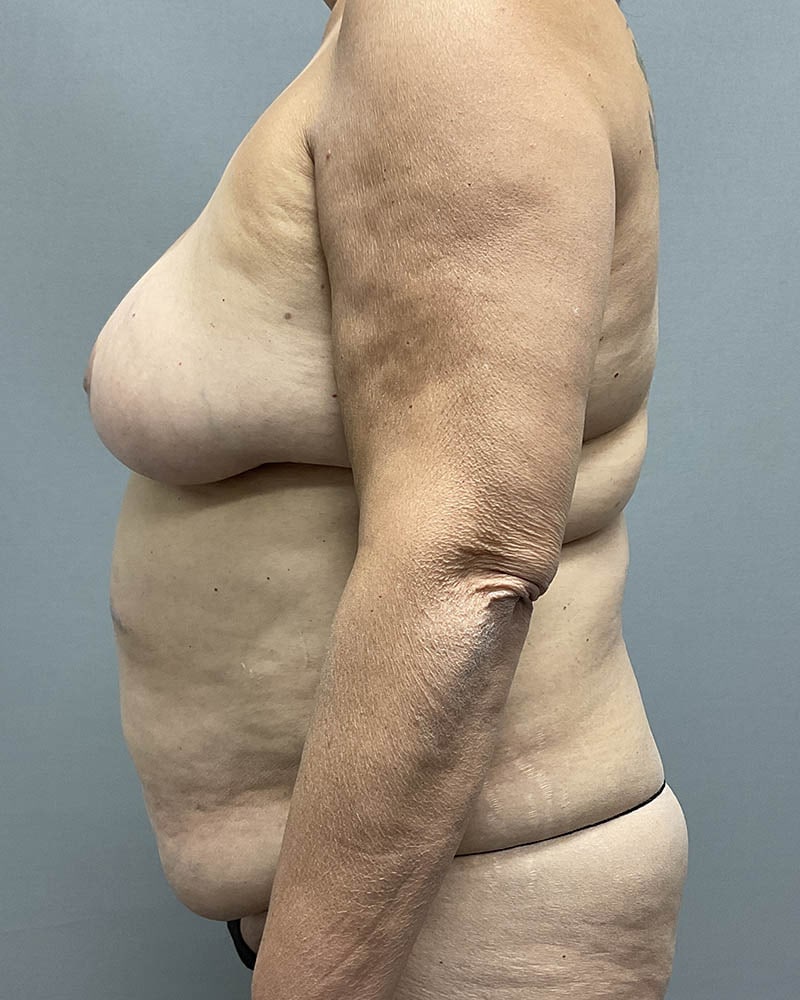 Liposuction Before & After Image