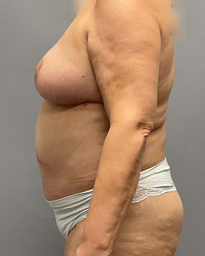 Liposuction Before & After Image