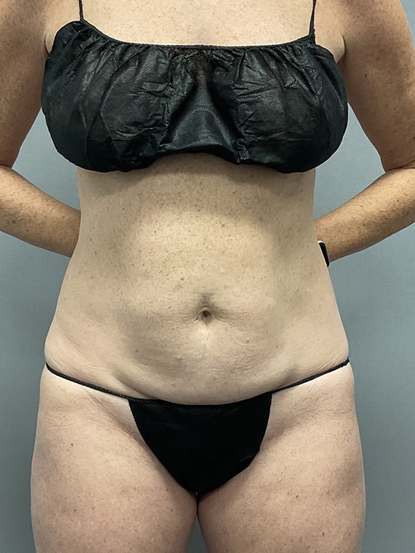 Liposuction Before & After Image
