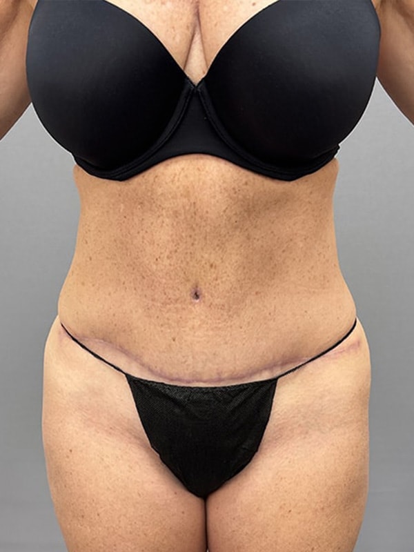 Liposuction Before & After Image