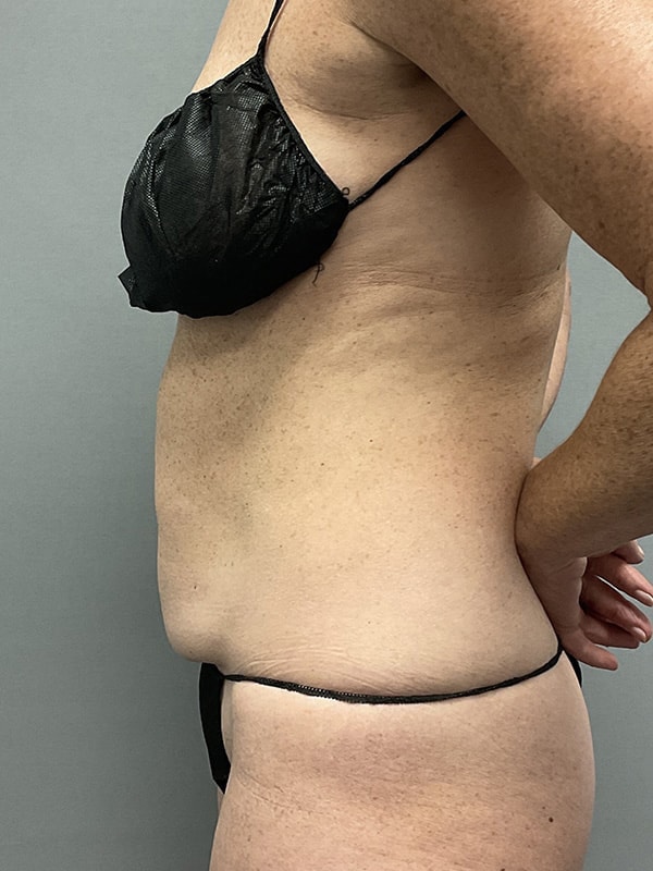 Liposuction Before & After Image