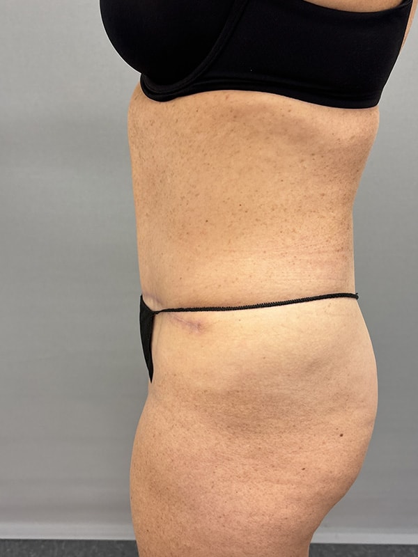 Liposuction Before & After Image