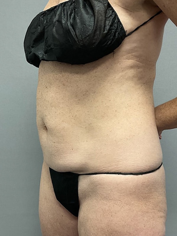 Liposuction Before & After Image